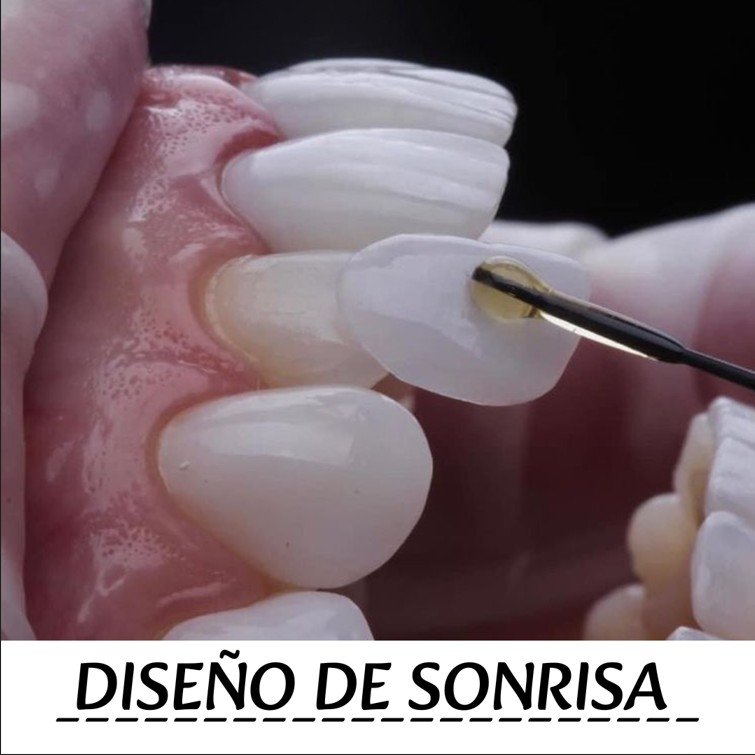 DISEÑO DE SONRISA