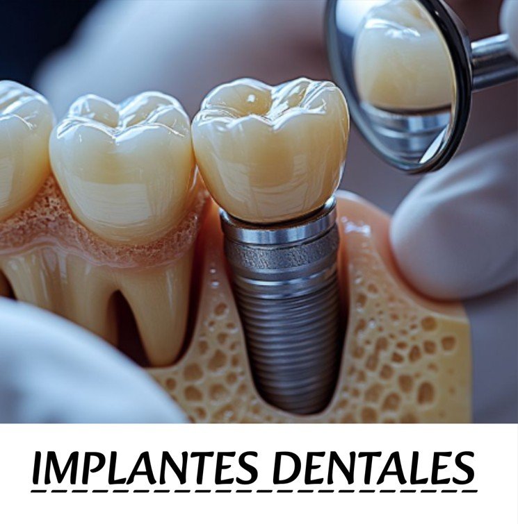 IMPLANTES DENTALES
